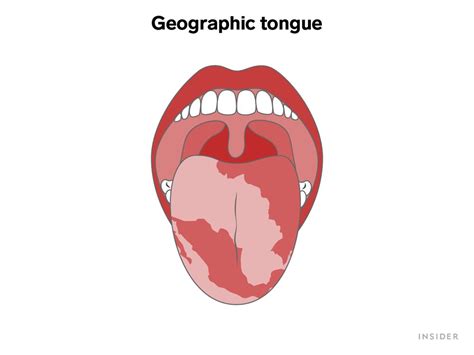 Painless Red Spot On Tongue