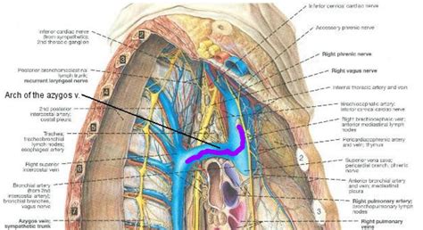 Learning Radiology Central Venous Catheter Azygos Vein