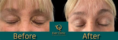 Xanthelasma Removal Glasgow Laser Treatment Clinic Scotland