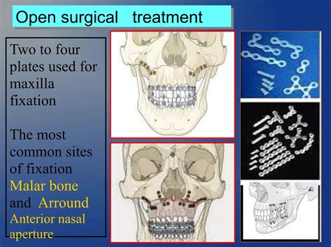 Mid Face Fracture Maxillary Fracture PPT