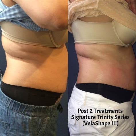 Velashape Iii Body Contouring Non Invasive Lipo The Skin Source