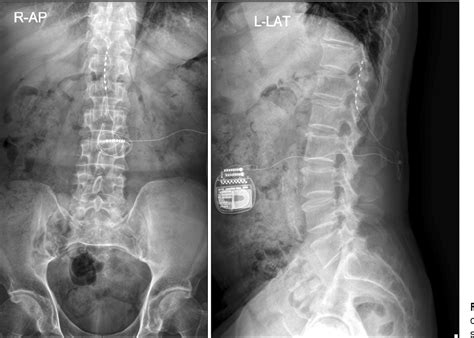 Figure 1 From Ultrasound Guided Placement Of A Permanent Peripheral