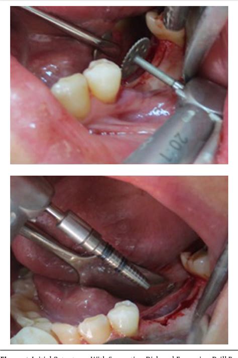 Figure From Mandibular Ridge Splitting And Gradual Bone Expansion