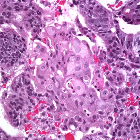 Webpathology A Collection Of Surgical Pathology Images