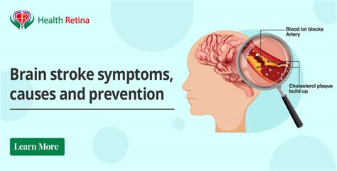 Brain stroke symptoms, causes and prevention - Health Retina