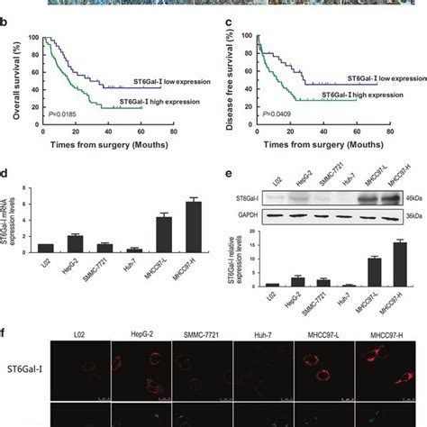 ST6Gal I Is Highly Expressed In HCC Cells And Tumor Tissues A IHC