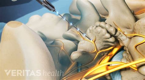 Radiofrequency Neurotomy For Facet And Sacroiliac Joint Pain