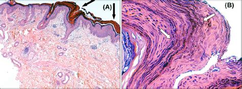 Histopathologic Examination Of A Punch Biopsy Taken From The Patients