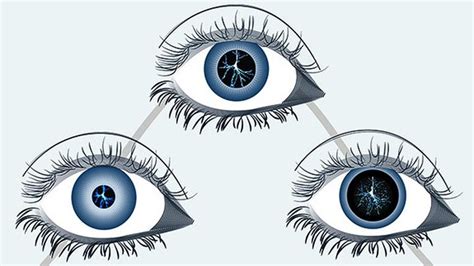 Pupil Size of Eyes Can Predict Death and Hospital Readmission in Heart ...