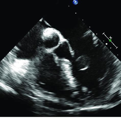 Preoperative Transesophageal Echocardiography A 15 Mm Cystic Round Download Scientific Diagram