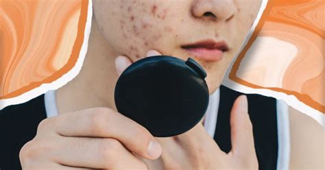 Adult Acne Causes And How To Treat It According To Experts Metro News