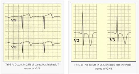 What is pseudo-wellens' Syndrome? - CARDIAC BOOTCAMP