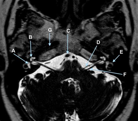 High Resolution Axial T2 Weighted Magnetic Resonance Imaging Of The