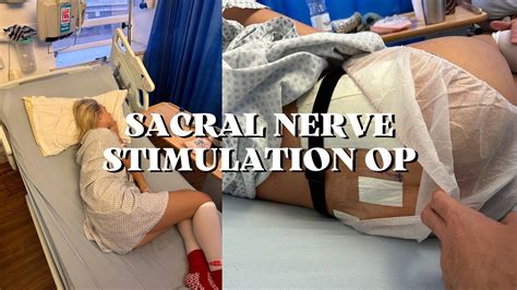 Sacral Nerve Stimulation Fowler S Syndrome Youtube