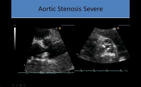 Stenosis: Bicuspid Aortic Valve Stenosis