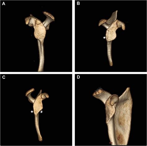 Glenoid Morphology In Obstetrical Brachial Plexus Lesion A Three