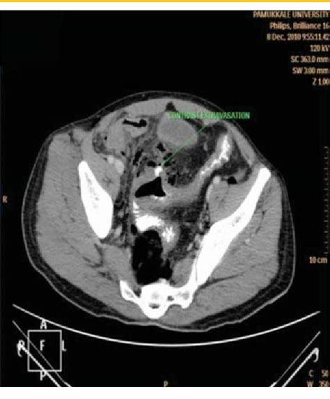 Figure 3 From Management Of Iatrogenic Perforations During Colonoscopy Semantic Scholar