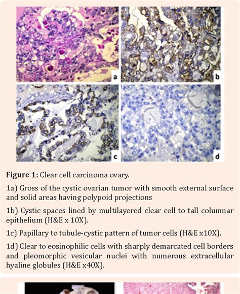 Clear Cell Adenocarcinoma Ovary