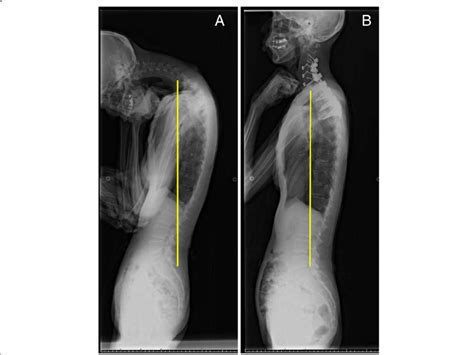 A Representative Case Of Type1 C7 Plum Line Is Drowned In Each