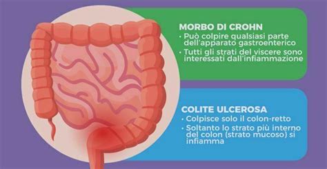 Malattie Infiammatorie Intestinali La Terapia Nutrizionale Mette A