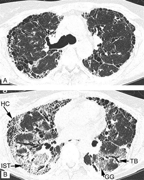 Nitrofurantoin Induced Pulmonary Fibrosis A Case Report Journal Of