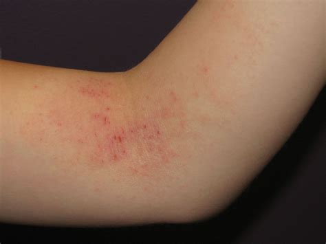 Skin Rashes On Elbows Pictures Photos Images