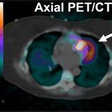 Example Of Cardiac PET CT Perfusion Exam With PET And CT Misalignment