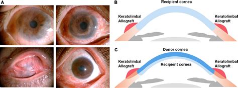 Frontiers Outcome Of Keratolimbal Allograft Transplantation With Deep