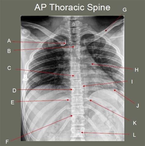 AP Thoracic Spine Mayo Radiograph Diagram Quizlet