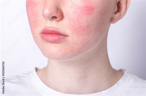 Rosacea Couperose Redness Skin Red Spots On Cheeks Young Woman With Sensitive Skin Patient