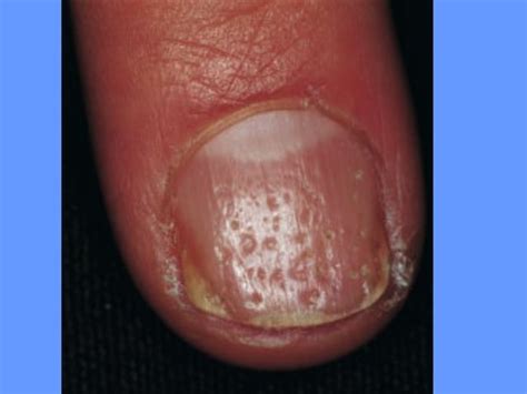 Nail Disorder Dr Aisha Almoosa Ppt