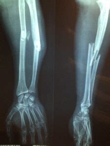 The Remarkable Process Behind Broken Bone Healing - Hampton Roads ...