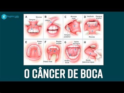 O que pode ser o caroço no céu da boca e como tratar 4 видео Med