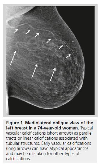 Mammography Of Breast Calcifications