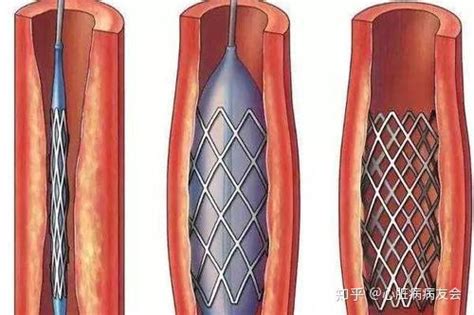 支架术后做完心脏支架后护理方法 知乎