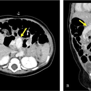 Abdominal Contrast Enhanced Computed Tomography Ct Findings Axial