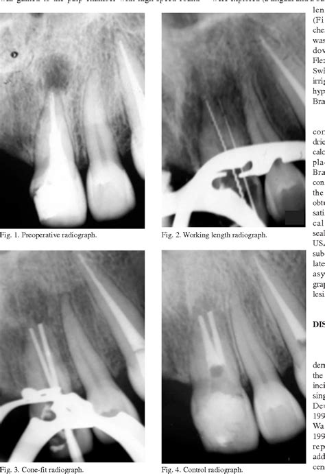 Figure 1 From A Case Of Unusual Anatomy Maxillary Central Incisor With