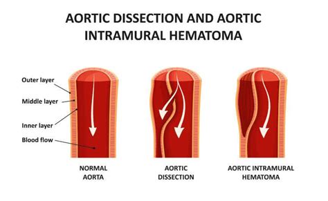 Dissezione Aortica Cosa E In Cosa Consiste Vivere Pi Sani