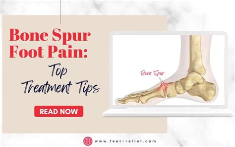 Bone Spur Foot Pain Top Treatment Tips Feet Relief