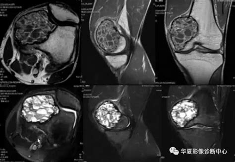 10个典型病例，让你学会骨肿瘤的诊断思路！ 好医术早读文章 好医术 赋能医生守护生命