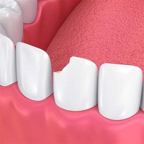 Cracked Tooth: 5 Symptoms And How To Repair Easily