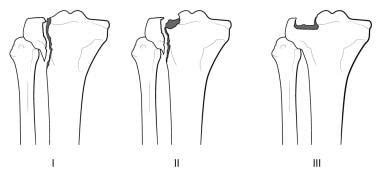 Tibia And Fibula Fracture