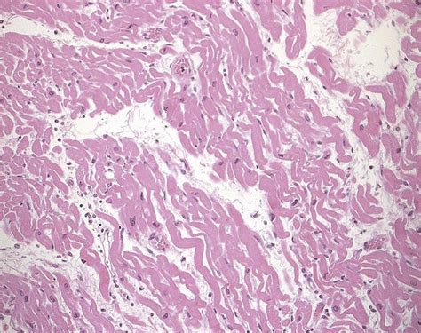 Pathology Of Myocardial Infarction Diagnostic Histopathology