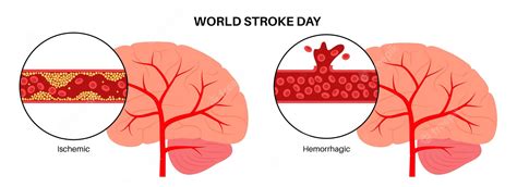 Premium Vector Brain Stroke Ishemic And Hemorrhagic