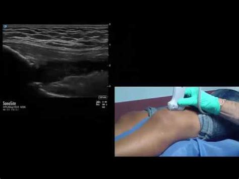 Step By Step Ultrasound Guided Intra Articular Knee Aspiration