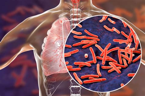 Tuberculosis TB In Singapore Interventional Pulmonology Clinic