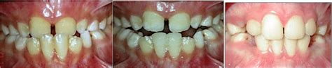 Correction Of Anterior Crossbite By Bonded Resin Composite Plane On