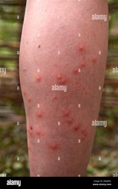 Medical Mosquito Bites Hi Res Stock Photography And Images Alamy