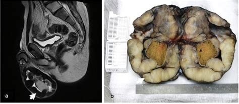 Paratesticular Fibrous Pseudotumor A New Entity Of Igg4 Related Disease