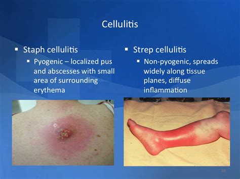 Strep Vs Staph Cellulitis